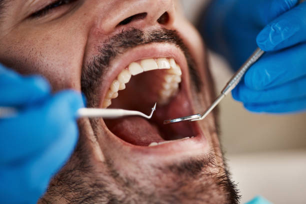 Best Emergency Wisdom Teeth Removal in Maize, KS